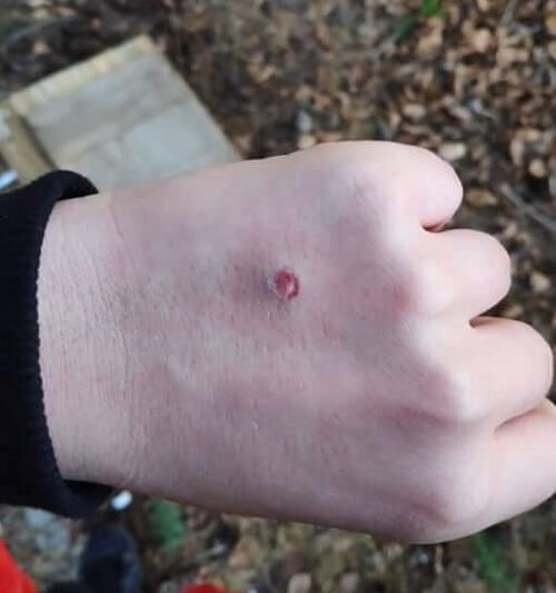 Airsoft wound on a fist caused in a game